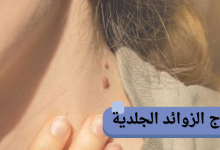 علاج الزوائد الجلدية: أفضل الطرق الطبية والطبيعية للتخلص منها بأمان