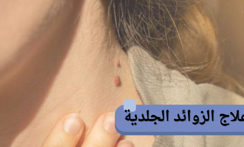 علاج الزوائد الجلدية: أفضل الطرق الطبية والطبيعية للتخلص منها بأمان